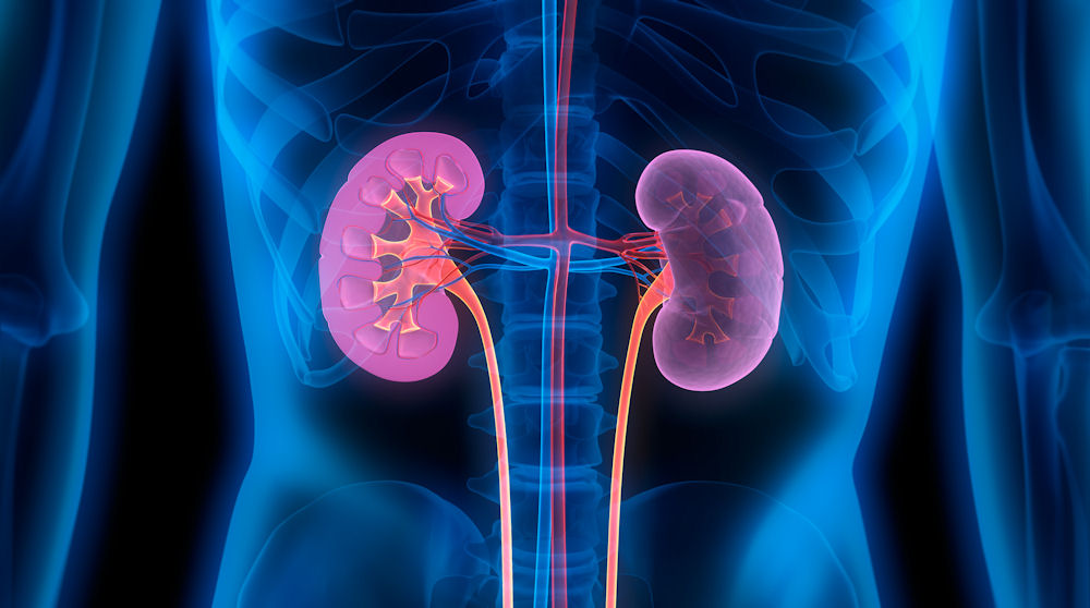 kidney stones